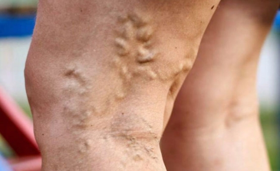 Krampfadern Bewährte Mittel aus dem Kloster Naturheilkunde