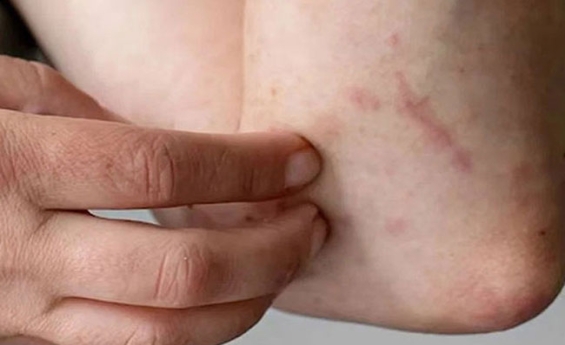 Juckreiz lindern mit der Kraft der Klosterheilkunde