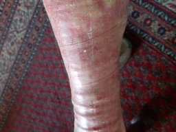 psoriasis