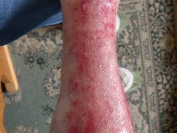 psoriasis