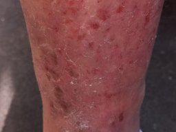 psoriasis