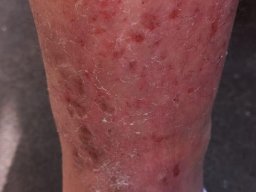 psoriasis