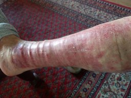 psoriasis